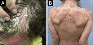 Clinical presentations of psoriasis – (A) Erythrodermic with scalp involvement, (B) Pustular.