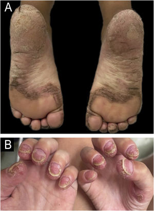Clinical presentations of psoriasis – (A) Plantar, (B) Nail and palmar.