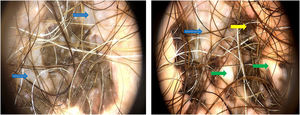 Dermoscopy (20× magnification; FotoFinder digital dermoscopy system) showing white scar-like areas (green arrows), gray-blue regression structures (blue arrows), and a blotch (yellow arrow).
