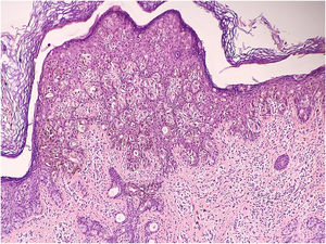 Histopathological image revealing large, vacuolated atypical cells with pale cytoplasm, hyperchromatic nuclei, prominent nucleoli, and occasional mitotic figures spreading in the epidermis in a pagetoid pattern. Dendritic melanocytes are seen interspersed among these cells and focal inflammatory infiltrate admixed with melanophages in the dermis (Hematoxylin & eosin, ×100).