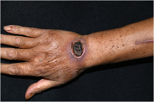 An annular ulcer with a raised border and central eschar on right wrist.