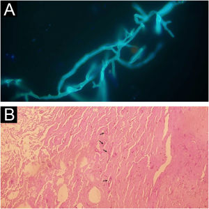 (A) Direct smear of exudate specimen showing broad, irregular, ribbon-like hyphae (calcofluor white ×400). (B) A large number of irregular hyphae (arrows) in the dermis layer (PAS × 400).