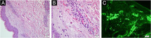 (A–B) Histopathological findings compatible with urticarial vasculitis, showing inflammatory cell infiltration in and around the dermal vessel walls, including neutrophils and eosinophils, together with erythrocyte extravasation (A, Hematoxylin & eosin stain, ×200; B, Hematoxylin & eosin stain, ×600). (C) Direct immunofluorescence showing fibrinogen deposition in the vessel walls. These findings were interpreted in conjunction with the clinical presentation.