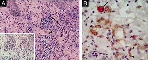 Sweet’s syndrome. Case 10. (A) Perivascular and interstitial inflammatory infiltrate of neutrophils (arrow) and histiocytoid cells (arrow-head). (B) CD163 + MPO+ macrophages (arrow), CD163 + MPO− and CD163 − MPO+ histiocytoid cells (arrow heads). Hematoxylin & eosin, 200×; Hematoxylin & eosin detail and double immunostaining, 400 × .