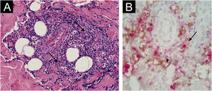 Acute neutrophilic vasculitis. Case 10. (A) Neutrophilic perivascular infiltrate (arrows). (B) CD163 + MPO− (arrow-head) and CD163 + MPO+ macrophages (arrow). Hematoxylin & eosin, 200×; Double immunostaining, 400×.