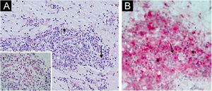 Type 2 leprosy reaction. Case 2: (A) Numerous histiocytoid cells (arrow) and neutrophils (arrow-head) around vessels. (B) CD163 − MPO+ polymorphonuclear (arrow heads) and histiocytoid cells (arrow). Hematoxylin & eosin, 200×; Hematoxylin & eosin detail and double immunostaining, 400×.
