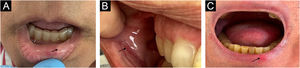 Clinical image: (A) Yellowish plaque on the inner surface of the lower lip (arrow). (B) Erythematous eroded plaque on the buccal mucosa (arrow). (C) Erythematous plaque on the lower lip (arrow).