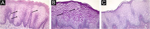 (A) Haematoxylin & eosin, 100 × . Enlarged suprabasal keratinocytes exhibiting abundant pale cytoplasm and small centrally located nuclei (arrows). (B) Periodic acid–Schiff, 100 × . Strong intracytoplasmic positivity (arrows). (C) Periodic Acid-Schiff with Diastase, 100 × . Loss of staining after diastase.