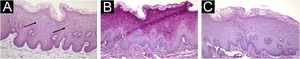 (A) Haematoxylin & eosin, 100 × . Prominent clear keratinocytes lacking nuclear atypia or architectural disturbance (arrows). (B) Periodic acid-Schiff, 100 × . Strong intracytoplasmic positivity. (C) Periodic Acid-Schiff with Diastase, 100 × . Loss of staining after diastase.