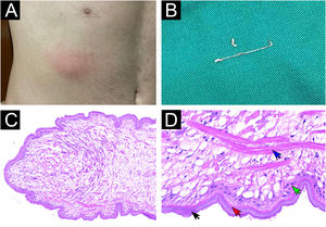 Sparganosis. (A) Erythematous subcutaneous nodule measuring approximately 3 cm on the right flank. (B) Macroscopic appearance of a plerocercoid larva of a cestode of the genus Spirometra, showing an elongated, flattened white worm. (C–D) Histopathology of the sparganum. The body wall is composed of tegument (black arrow), two thin layers of muscle cells (red arrow), and tegumentary cells (green arrow). The central portion consists of loose stroma containing muscle fibers (blue arrow) and calcareous bodies (not visible in these images), without identifiable internal organs. (Hematoxylin & eosin, 100× and 400×).