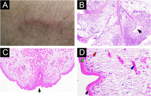 Sparganosis. (A) Erythematous serpiginous lesion on the medial aspect of the right thigh. (B) Histopathology revealing lobular panniculitis with a dense mixed inflammatory infiltrate surrounding a tract (black arrow) lacking epithelial lining (Hematoxylin & eosin, 20×). (C) Histologic section of the anterior portion of the worm showing the bothrium (black arrow) (Hematoxylin & eosin, 100×). (D) High-power view of the sparganum. The tegument (black arrow) and tegumentary cells (green arrow) are observed in the body wall, while calcareous bodies (red arrow) and muscle fibers (blue arrow) are present in the central portion of the worm. Note the absence of internal organs (Hematoxylin & eosin, 400×).