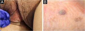 Vulvar cyst. (A) Clinical features showing a bluish papule on the right labium majus. (B) Dermoscopic image of the lesion revealing a well-defined blue papule with a homogenous pattern (non-polarized light, non-contactdermoscopy, original magnification 10×).