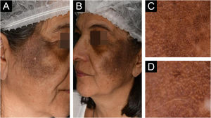 Extensive, confluent dark brown hyperpigmented macules arranged in a photo-distributed pattern. (A and B) Bilateral involvement of the malar region, including the zygomatic and periocular areas, with extension toward the cheeks. (C and D) Dermoscopic image: Presence of perifollicular coarse gray-blue globules, without obliteration of follicular openings by pigment.