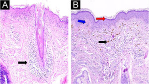 Skin biopsy stained with hematoxylin and eosin. (A) 40× magnification, corresponds to an earlier stage of the process. A mononuclear lymphohistiocytic infiltrate is observed following the follicular epithelium (black arrow). No interface damage, mucin deposition, or significant epidermal alterations are identified. These findings are suggestive of follicular LP. (B) 10× magnification, represents a later stage, characterized by postinflammatory pigmentary changes. Epidermal atrophy (red arrow), interface alteration (blue arrow), pigment incontinence (black arrow), and prominent melanophages (black arrow) are evident. Clinicopathological correlation supported the diagnosis of LPP.