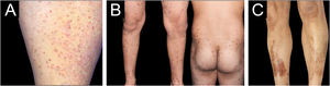 Representative clinical features of Pigmented Purpuric Dermatoses (PPD) subtypes in this series: (A) Majocchi