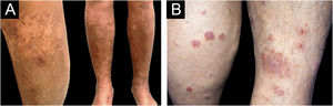 Representative clinical features of Pigmented Purpuric Dermatoses (PPD) subtypes in this series: (A) Gougerot-Blum pigmented purpuric lichenoid dermatitis ‒ coalescing brownish papules and macules with purpuric and lichenoid areas on the lower limbs. (B) Doucas-Kapetanakis eczematid-like purpura ‒ annular erythematoviolaceous eczematous plaques with a purpuric center and peripheral scale on the lower limbs.