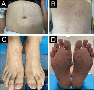 Retiform purpura on the abdomen (a), back (b), lower limbs (c), and feet (d).