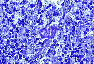 Small PAS-positive grain between granulomatous inflammatory infiltrate (PAS, 40×).