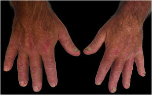 Nail dystrophy of the left hand, characterized by thickening, irregularity, and discoloration of the nails, consistent with nail involvement secondary to psoriasis.