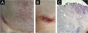 (A) Ulcerated lesion on the right flank at the adalimumab injection site. (B) Detail of the lesion, showing ulceration. (C) Histological section stained with hematoxylin & eosin, ×40 magnification, showing mild reactive epithelial hyperplasia, dermal granulation tissue, and mixed inflammatory infiltrate, with an ulcerated base containing fibrin and neutrophils.