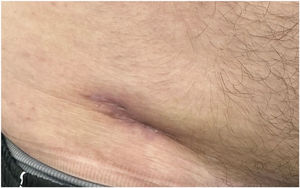 Residual scar following treatment and resolution of the infection.