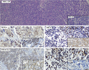 Immunohistochemical evaluation of MCPyV, PKCε, PD-L2, and AKT-1 expression. Representative immunohistochemical staining in Merkel Cell Carcinoma (MCC), including Hematoxylin-Eosin (H&E) morphology and expression of MCPyV, PKCε, PD-L2, and AKT-1. MCPyV positivity was observed in approximately 63% of cases, showing predominantly nuclear staining in tumor cells. PKCε exhibited cytoplasmic positivity, with significantly higher expression in MCPyV-positive tumors. PD-L2 demonstrated strong membranous and cytoplasmic staining in 92.6% (25/27) of cases, with high proportions of marked tumor cells, supporting immune checkpoint activation. AKT-1 showed diffuse cytoplasmic positivity in 100% of tumors, with moderate-to-strong intensity, indicating activation of the PI3K/AKT pathway.