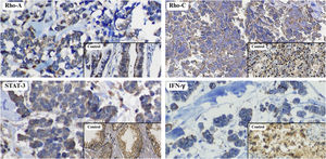 Immunohistochemical characterization of RhoA, RhoC, STAT3, and IFN-γ expression highlighting Rho/STAT pathway activation. Immunohistochemical expression of RhoA, RhoC, STAT3, and IFN-γ in MCC samples. RhoC and STAT3 showed diffuse and strong positivity in 100% of cases, with cytoplasmic staining for RhoC and predominantly nuclear staining for STAT3, involving a high percentage of tumor cells. RhoA demonstrated cytoplasmic positivity in 92.6% of tumors, with higher expression in MCPyV-positive and sun-exposed lesions. IFN-γ expression was low or absent in most cases, showing weak and focal cytoplasmic staining in a small proportion of tumor cells, indicating limited immune activation.