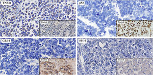 Immunohistochemical assessment of TNF-α, p53, GLI-1, and SHH expression demonstrating limited tumor suppressor and Hedgehog pathway activation. Legend: Immunohistochemical analysis of TNF-α, p53, GLI-1, and SHH in MCC. TNF-α showed low-to-moderate cytoplasmic positivity, without significant differences according to MCPyV status. p53 expression was generally low, with weak nuclear staining in a small percentage of tumor cells. GLI-1 and SHH were negative in all cases, with absence of nuclear (GLI-1) and cytoplasmic (SHH) staining, indicating no detectable activation of the Hedgehog pathway in this cohort.