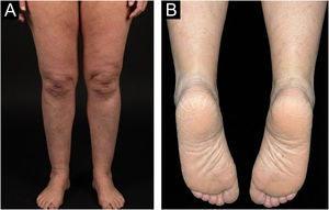 Clinical photographs two weeks after initiation of ixekizumab therapy. (A) Anterior view of the lower extremities showing marked improvement with near-complete resolution of erythema and scaling. (B) Plantar surfaces with significant improvement in keratoderma.