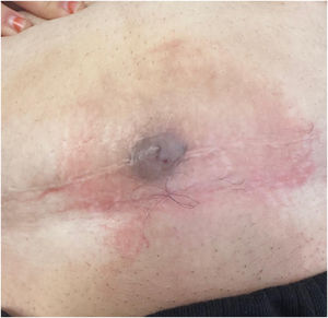 Clinical photograph showing a well-circumscribed, bluish-gray nodular lesion arising at the midline of the caesarean section scar.