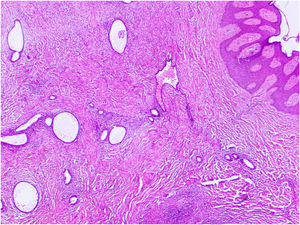 Endometrial glands surrounded by endometrial stroma within the dermis (Hematoxylin & eosin, ×400).