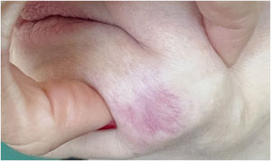Erythematous nodule with telangiectasia.
