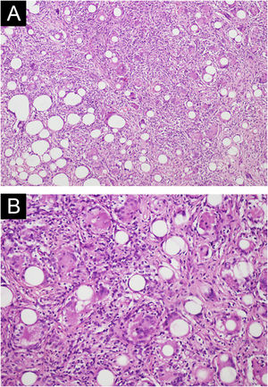(A) Histological findings of diffuse nodular inflammatory infiltrate composed of foreign body-type giant cells containing single regular microspheres within their cytoplasm, interspersed with macrophages, lymphocytes, and fibroblasts. Hematoxylin and eosin, 100×. (B) Higher magnification of the granuloma showing microspheres with similar diameters. Hematoxylin & eosin, 200×.