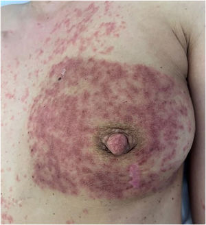 Well-demarcated, confluent, erythematous papules and plaques confined to the irradiated breast.