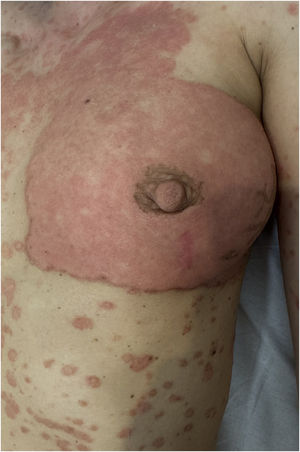The breast lesion gradually faded into a milder phenotype that resembled the new plaques.
