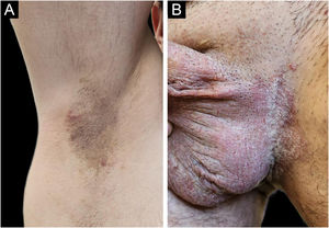 Baseline clinical findings. (A) Active erosive axillary plaque with maceration. (B) Severe inguinal and genital involvement characterized by erythema, maceration, superficial erosions, and fissuring prior to initiation of upadacitinib therapy.