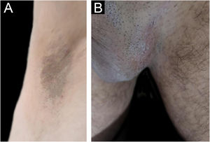 Clinical response at week-4 following initiation of upadacitinib 15 mg once daily with adjunctive zinc oxide barrier care. (A) Marked improvement of the axillary lesion, with near-complete resolution of erosions and residual post-inflammatory hyperpigmentation. (B) Marked improvement of the inguinal and genital lesions, with substantial re-epithelialization and residual mild erythema.