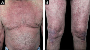 (A‒B) Patient 2. 65-year-old patient with stage IV lung adenocarcinoma presenting with a Grade 3 Maculopapular Rash (MPR): confluent and slightly scaly maculopapular lesions with intense erythema in the trunk and extremities covering > 30% Body Surface Area (BSA).
