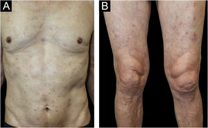 (A‒B) Patient 4. 66-year-old-patient with stage IV lung squamous cell carcinoma presenting with a Grade 2 MPR: Scattered erythematous maculopapular lesions in the trunk and thighs, covering 10%–30% BSA.