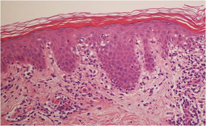 Histology image of biopsy taken from patient 4 (Hematoxylin & eosin, 10×). Lichenoid interface dermatitis; moderate lymphoid infiltrate in the upper dermis with interface damage in the basal epidermis and necrotic keratinocytes.