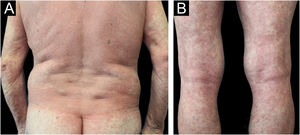 (A‒B) Patient 6. 71-year-old patient with stage IV lung squamous cell carcinoma presenting with a Grade 3 MPR: confluent maculopapular lesions with intense erythema, more pronounced in pressure-dependent areas, covering > 30% BSA.