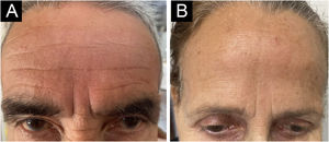 (A) Most common glabellar wrinkle pattern: two vertical lines with a horizontal wrinkle; the patient also has four well-defined forehead wrinkles. (B) Second most common pattern: three vertical lines with a horizontal wrinkle.