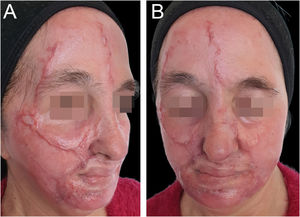 Hypertrophic scarring following TCA-croton oil peel with a linear and geographic distribution pattern. (A) Right oblique view showing well-demarcated erythematous hypertrophic scars along the forehead, periorbital, malar, and perioral regions. (B) Frontal view highlighting the symmetric distribution of lesions, with prominent perioral involvement and areas of crusting and incomplete re-epithelialization.