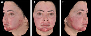 Severe hypertrophic scarring following TCA-croton oil peel. (A) Left lateral view showing marked erythema, dermal thickening, and involvement of the mandibular and perioral regions. (B) Frontal view demonstrating diffuse facial erythema with prominent perioral fibrosis. (C) Right lateral view highlighting extensive scarring affecting the malar and perioral areas, with evident tissue contraction.