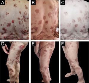 Sequential clinical improvement in pemphigus vulgaris at baseline (A‒D), one month (B‒E), and six months (C‒F). At baseline, multiple erosive plaques involving the trunk and extremities were observed (A‒D), with a PDAI score of 73 (activity: 60, damage: 13), indicating severe disease. After one month of treatment, re-epithelialization of erosions with post-inflammatory hyperpigmentation was evident (B‒E), reflected by a decrease in PDAI to 21 (activity: 12, damage: 9). At six months, further reduction in lesion activity and residual hyperpigmentation demonstrated sustained remission (C‒F), with a PDAI of 7 (activity: 3, damage: 4).