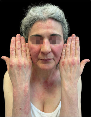 Clinical presentation at baseline. Heliotrope rash with periorbital erythema, V-sign erythema on the anterior chest, and Gottron papules over the metacarpophalangeal and interphalangeal joints. CDASI activity score: 26.