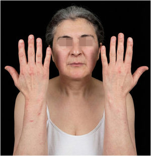 Clinical response 4-weeks after upadacitinib dose escalation to 30 mg daily. Near-complete resolution of facial erythema and V-sign, with significant fading of Gottron papules. CDASI activity score: 6.