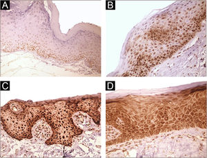 Expression profile of 8-OHdG in Actinic Cheilitis (AC). (A) Immunoreactivity score 1 in AC without epithelial dysplasia (100×). (B) Immunoreactivity score 2 in AC with mild epithelial dysplasia. Note the predominance of nuclear immunostaining (200×). (C) Immunoreactivity score 3 in AC with moderate epithelial dysplasia. Note the predominance of nuclear immunostaining (200×). (D) Immunoreactivity score 3 in AC with moderate epithelial dysplasia. Note the predominance of cytoplasmic staining (200×).