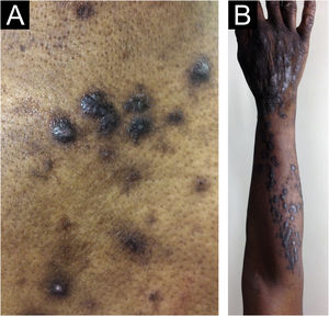 Chronic prurigo (CPG) and the elementary morphology of the lesions. (A) Papule (<1 cm in diameter) and nodules (>1 cm in diameter), (B) Coalescence of papules and nodules (plaque) and lesions in a linear arrangement.