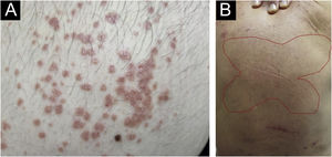 Prurigo chronica multiformis: (A) Multiple primary pruritic papular lesions usually expand or coalesce to form an infiltrated erythematous plaque lesion; (B) the “butterfly” sign, indicating an area of dorsal skin spared by excoriation due to inaccessibility.